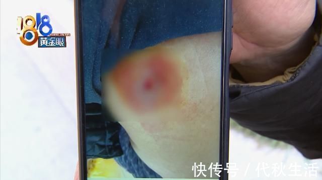 社区卫生院|四年前手术留下的引流管,最近才被取出来?