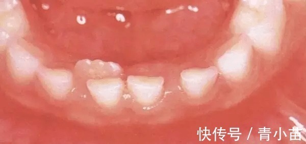 儿童|家长必读权威专家提醒：必须在12岁前处理的10种儿童牙颌畸形
