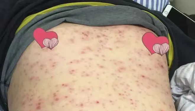 一旦感染终生携带 ,这种病毒太狡猾,还可能通过亲吻传播!