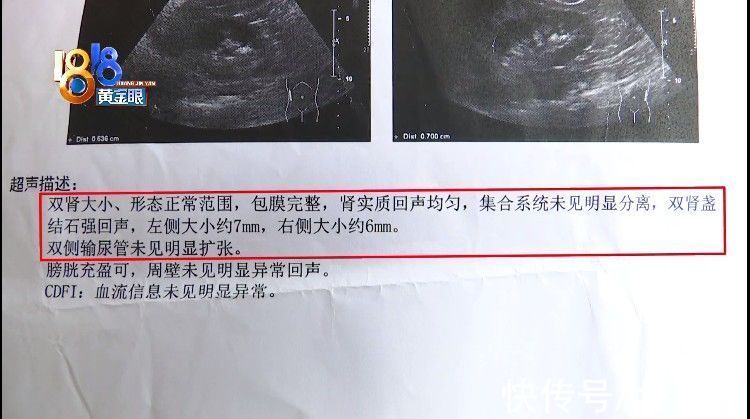 手术支架|术后小便一直出血,手术支架漏取一个