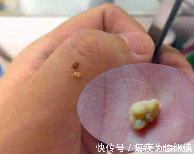 牙结石|6岁娃被嫌“嘴太臭”,遭同学排挤,医生掏出这东西,妈妈都捂鼻