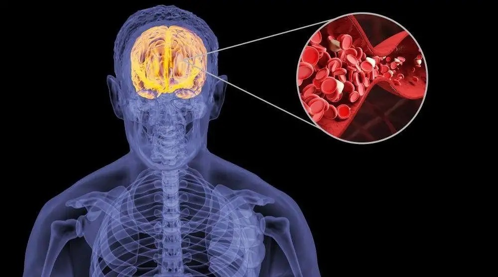 内膜|因为高血压进了ICU!别再拿高血压不当回事儿
