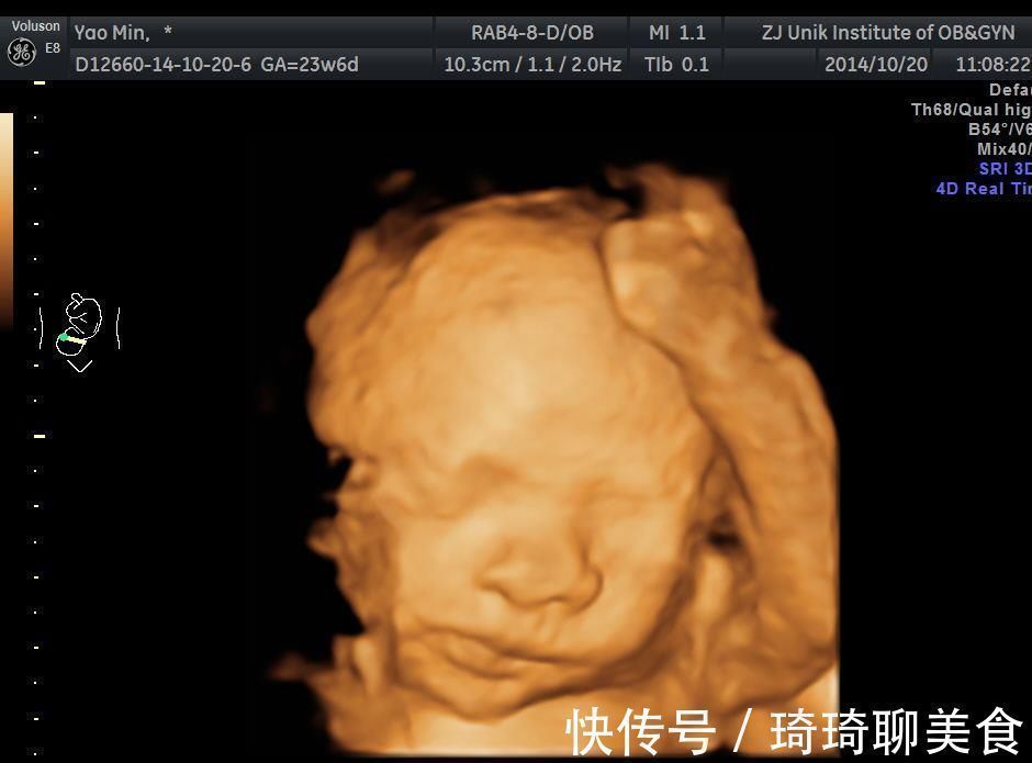 胎儿|孕妇做四维彩超,胎儿鼻子扁又大,胎儿也是有苦说不出啊!