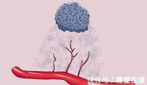 凝血功能|穿刺活檢會讓癌細胞擴散？哪些人需要做穿刺活檢？