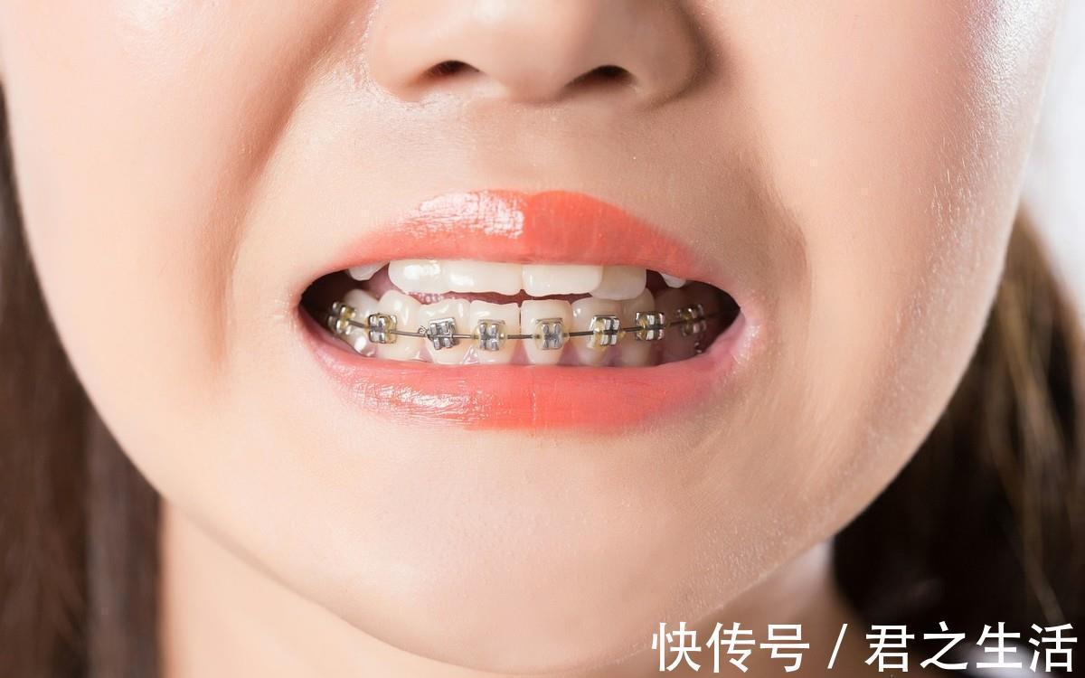 矫治|儿童做牙齿矫正三个最佳时间:家长要牢记,矫治越早干预效果越好