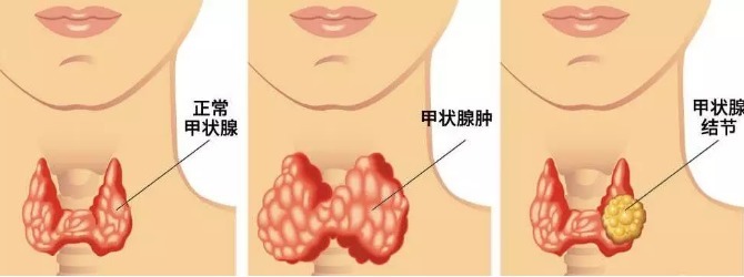 甲状腺|再三提醒甲状腺“癌变”时，身体会有3个异常，早治疗早痊愈