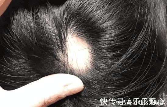 脱发类|医生提醒妈妈们给孩子扎辫子时不可用力过猛,会患上脱发类疾病!