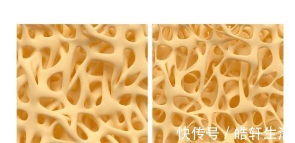 补钙|中老年人预防骨质疏松，光补钙还不够？加上2种营养，事半功倍