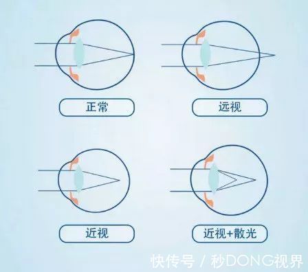 散光|【科普】---散光的危害!