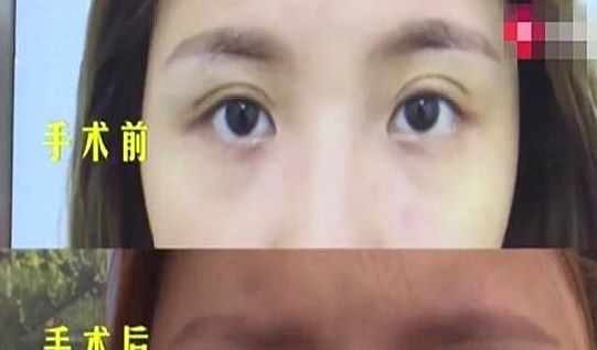 整容 女子去做双眼皮，术后却变成“三眼皮”，丈夫：变丑了，还变老了