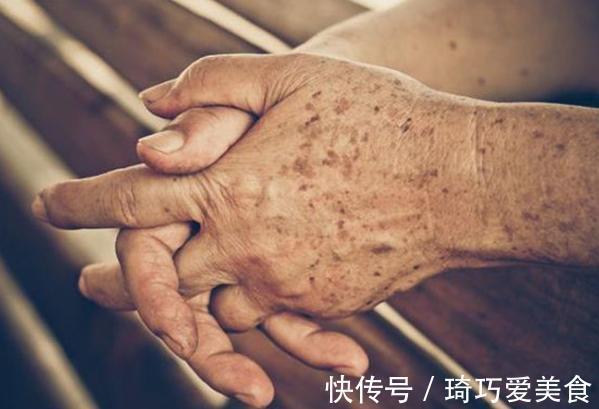 黑色素|老年斑除不掉怎么办?教你三个绝招,淡化老年斑,看上去更年轻