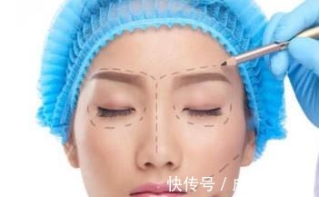 拉皮 拉皮除皱王小民教授32岁做小拉皮,变化有多大!