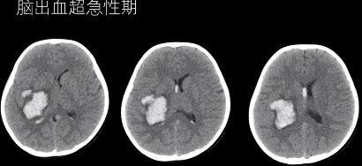 大脑血管疾病|5大脑血管疾病的MRI表现，一文总结