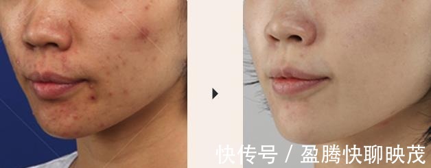 痘痘|天气越热、“痘痘”越多?3个原因+改善方法,瑕疵痘痘肌有救了