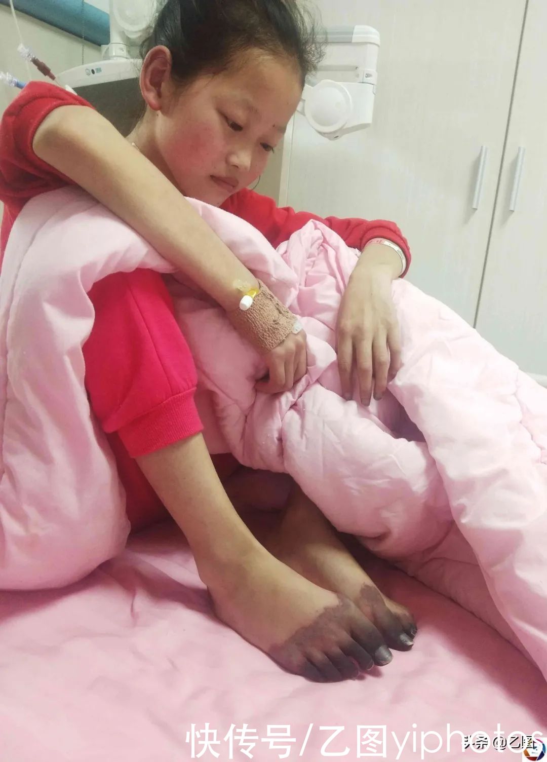 第一附属医院|花季少女患一种怪病，手脚从指头开始碳化，检查结果让父母崩溃