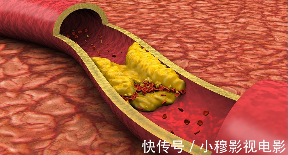 血管壁|高血脂患者，这3种“升脂”食物要忌口，