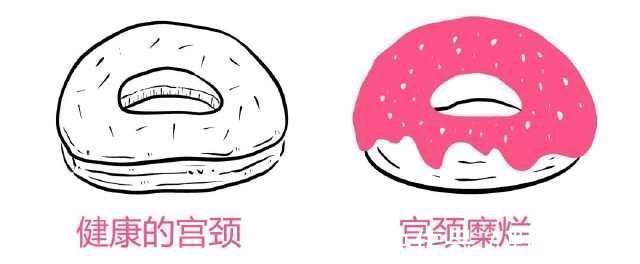 宫颈癌|撕碎妇科病的骗局：女人别再被骗了，这几种“妇科病”其实不用治