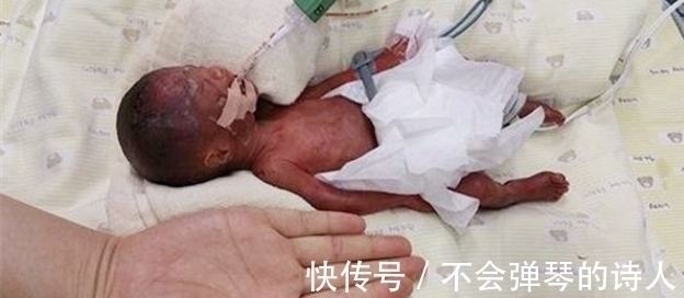 生命力|出生时仅25厘米的“拇指姑娘”,曾被断言活不过3月,却健康长大