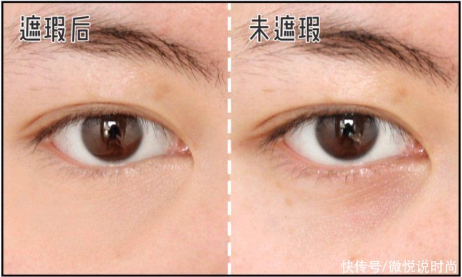 黑眼圈很严重怎么办？怎么拯救特别严重的黑眼圈？