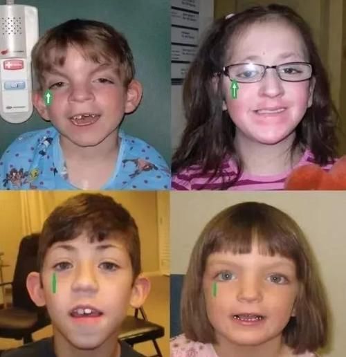 睫毛|宝宝长得太漂亮也是一种病?“歌舞伎综合征”到底是个什么鬼