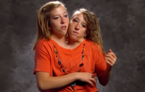 双胞胎|还记得国内首例“坐骨连体”双胞胎吗?13年过去了,她们现状如何