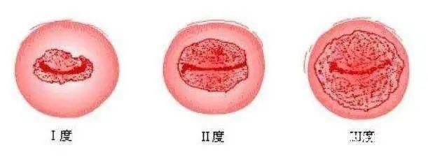 盆腔积液|5分钟教你看懂妇科体检报告单!有些病可能是唬人的“纸老虎”!