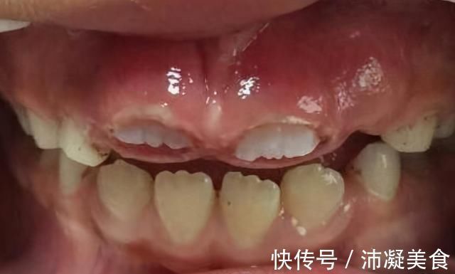 孩子|7岁孩子门牙掉了1年,一直长不出来,家长着急,该怎么办?