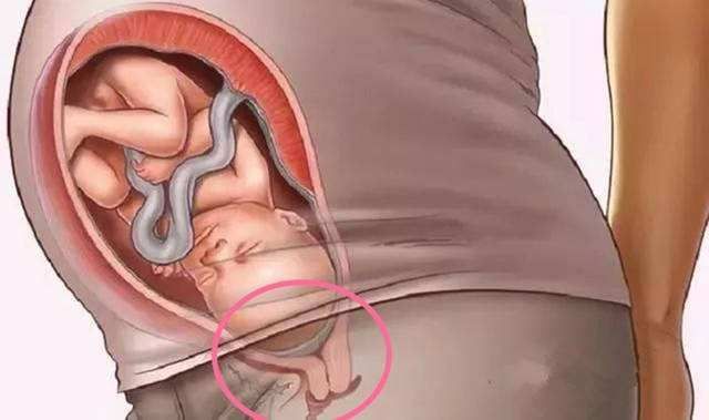 剖腹产|“悬浮肚”十产九剖,孕妈想要顺产,要满足这两个条件