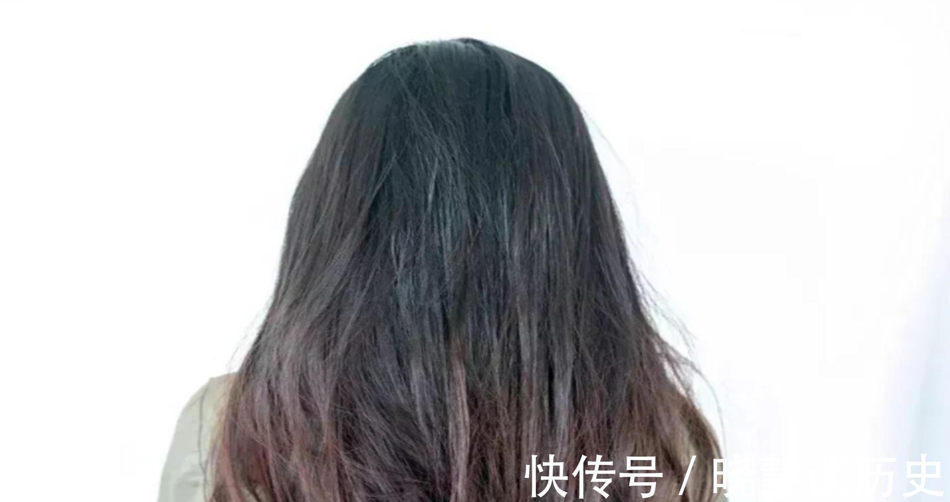 基因|每天掉超过100根头发是脱发？脱发5大元凶，少碰为妙