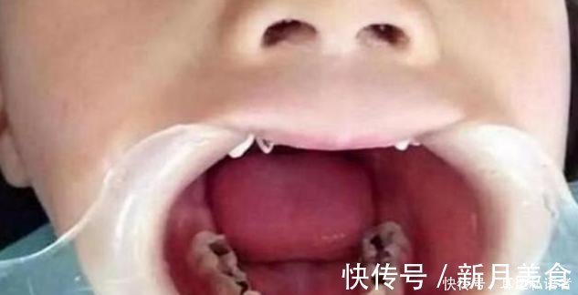 父母|3岁儿子满口“小黑牙”,罪魁祸首不是糖果,而是父母的无知