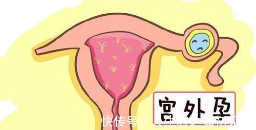 妇产科医生|女人怀上“宫外孕”,多半是男人的锅妇产科医生几句话挑出问题