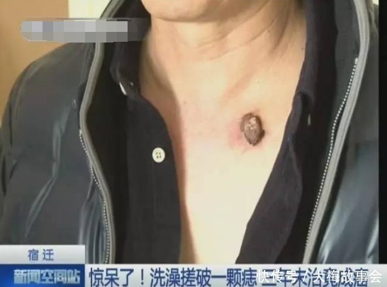 基底细胞癌|只因搓破身上一颗小痣，25岁男子患上癌，这些痣都需要谨慎
