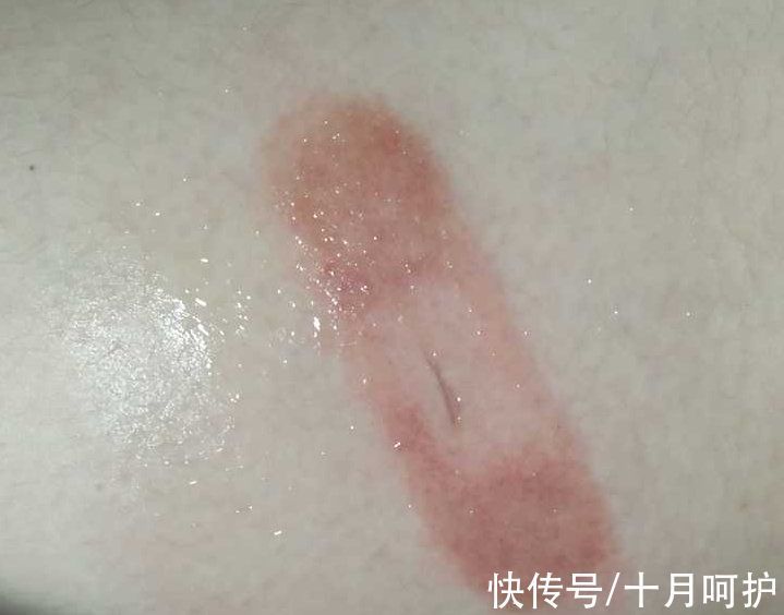 残疾|三岁女童被活活截断手指,终生残疾!只因用错创可贴,快自查