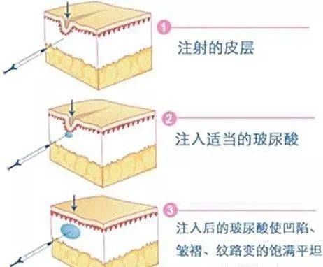 皮肤 济南海峡整形科普：颈纹要如何去除？