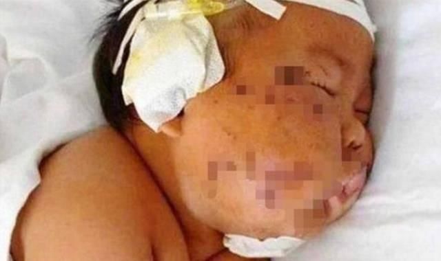 妈妈|4年前因吃奶太用力,被妈妈用剪刀划伤脸的男婴,现状惹人感慨