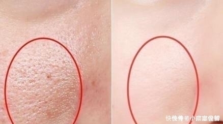 小疙瘩|抿紧下巴后突起的“白疙瘩”,千万要注意,这是螨虫的真身吗?