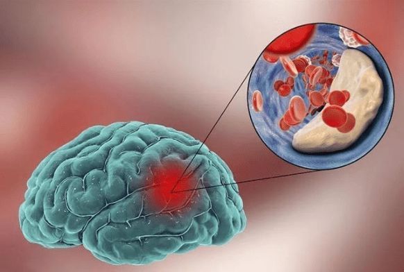 油条|3种早餐是“升脂大户”,鸡蛋未上榜,医生:血脂高的人尽量少吃