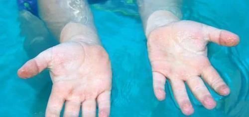 医生|男婴被100度开水烫伤后,妈妈做法遭全家反对,却得到医生点赞