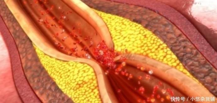 血脂|多走路可以降血脂？心血管医生：过了50岁，做好3件事更有效果