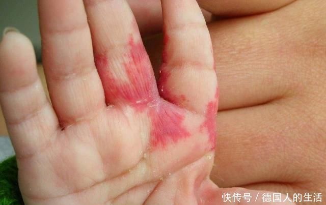 宝宝|孕妈在孕期,尽量不做4件事,避免宝宝脸上长胎记,孕妈别不在意