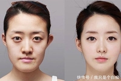 整容|男子为变成精灵王子,削尖耳朵整成怪物,网友:整容前太帅了