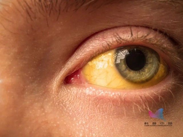 突眼|眼白变黄，表示肝有问题？注意！出现这几种，赶紧就医…