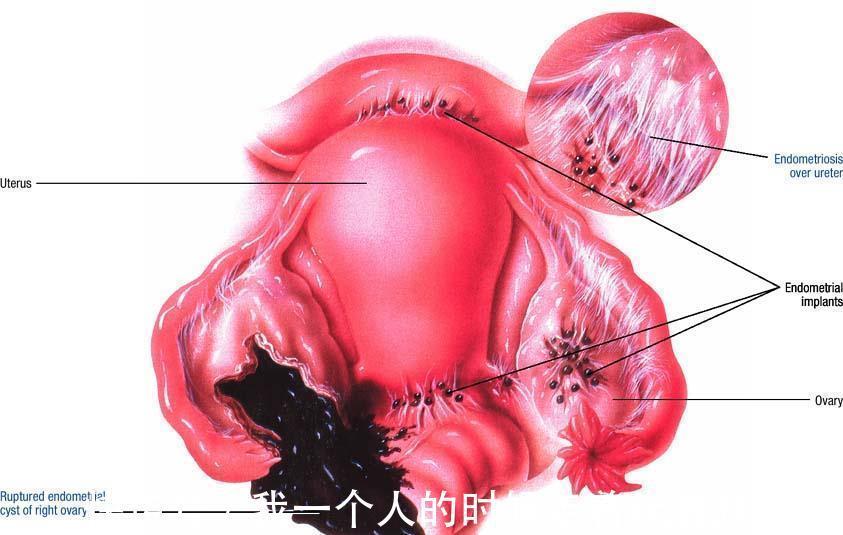 下腹部|关于女性慢性下腹痛，想知道有哪些常见原因吗？医生直接告诉你