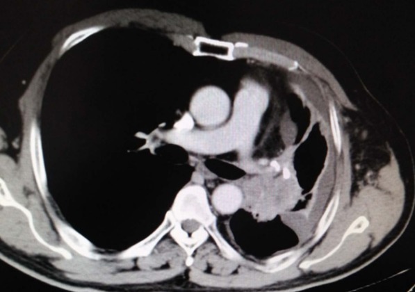 医生|肺癌一查就是晚期其实双腿早就给了信号,只是大多数人都忽视了