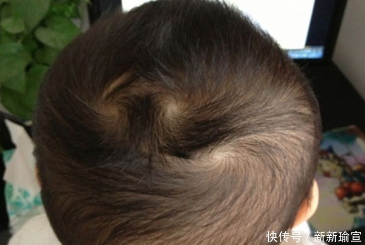 晓雯|孩子头顶上的“两个旋”代表啥?很多父母误解了,看完你就懂了