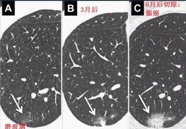 治疗|两个肺癌病人都拖了2年才治疗，一个治愈，一个扩散了