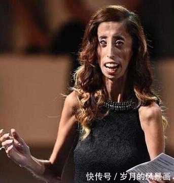 纪录|曾破吉尼斯最瘦纪录的骷髅女孩，只有27公斤，如今成励志女孩