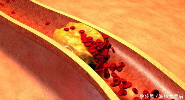 注重油|高血脂“祸根”找到了,专家建议:三种食物主动拒绝,血管自清