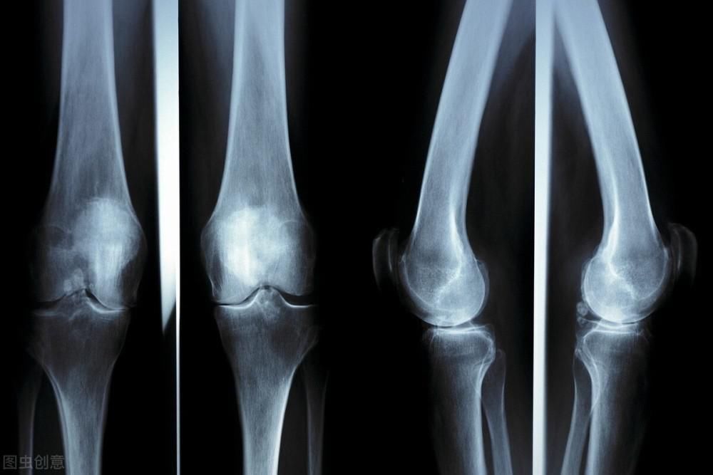 氨酸骨密素|骨科医生直言:骨质疏松的3个预防方法,比喝牛奶还有用,快收藏