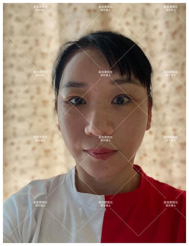 面部 51岁小拉皮术后1个月,我想跟大家说点真心话